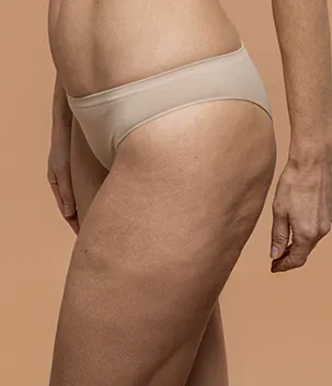 Celulite - Badra Medicina e Estética